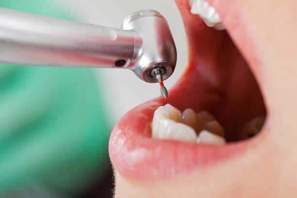 Best Emergency Wisdom Teeth Removal in Valencia West, AZ